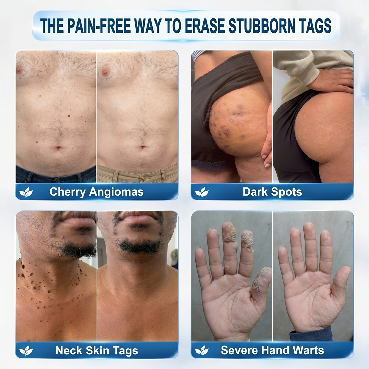 Only 10 left! 🌟 𝐇𝐢𝐬𝐤𝐢𝐧® Wart Removal Roll-On Pen is now 30% off—help reduce the appearance of warts in just 1–3 weeks. Once sold out, it won’t return until next year! 180-day money-back guarantee, completely risk-free.